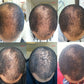 Kirkland 5% Suluhisho la Nguvu ya ziada ya Minoxidil kwa Wanaume