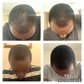 Kirkland 5% Suluhisho la Nguvu ya ziada ya Minoxidil kwa Wanaume